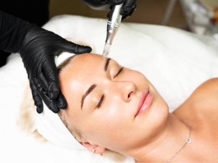 Skin needling collagen induction treatment